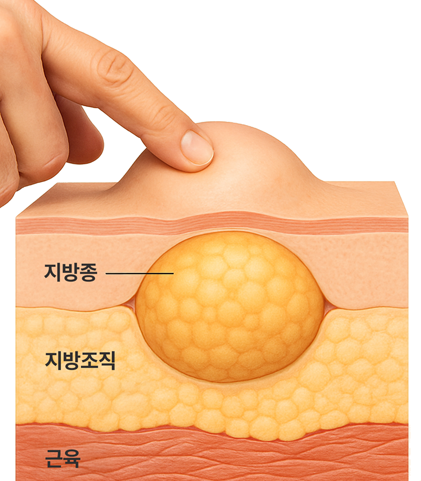 지방종 단면 일러스트
